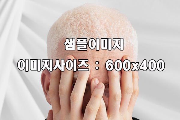 탈모 증상 예시 이미지